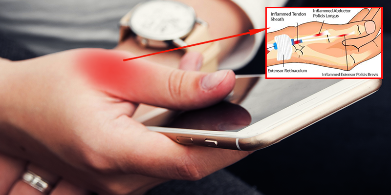 “TEXTING THUMB” your PROBLEM too? Here’s WHAT to do